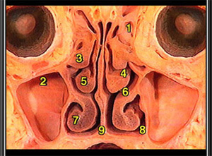 Fig 2: Front Mid face Cross Section: 3 - right superior turbinate, 5 - right middle, turbinate, 7 – right inferior turbinate.
